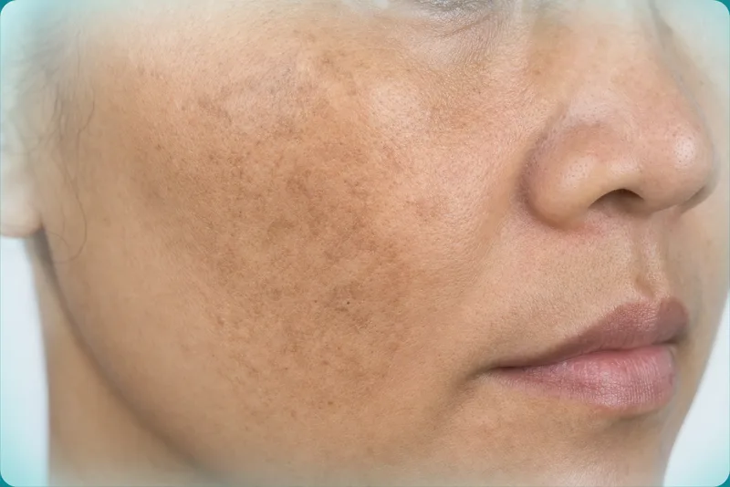 Close view of uneven facial pigment and melasma